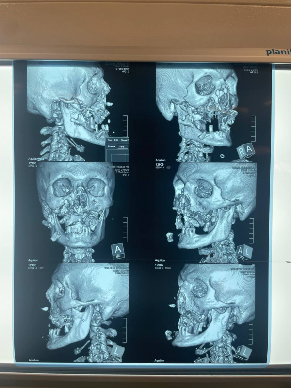 ﻿Мужчине из Красноярского края «пересобрали лицо» в хакасской больнице после встречи с медведем