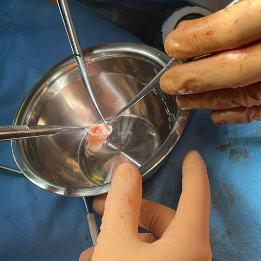 Красноярский кардиохирург прооперировал младенца с тяжелейшим пороком сердца в Иркутске