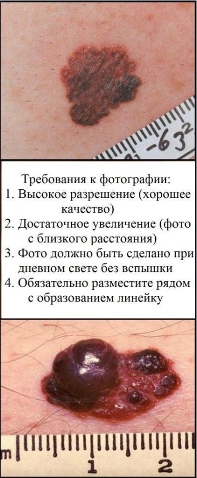 Красноярцев приглашают бесплатно проверить родинки на онкологию