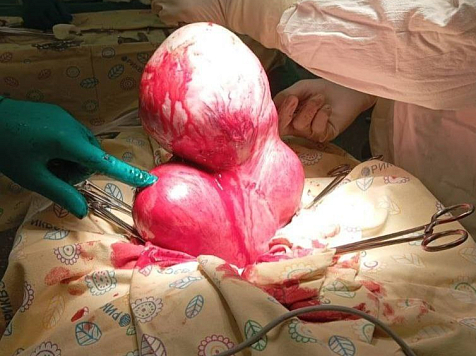 Красноярские врачи удалили опухоль размером 20 сантиметров. Фото: Минздрав Красноярского края