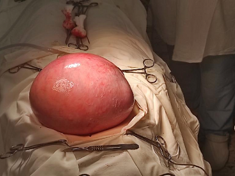 Красноярские врачи ФМБА удалили пациентке 5-килограммовую опухоль. Фото: skc-fmba.ru