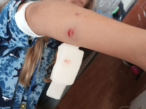 Бродячая собака в Иланском Красноярского края напала на 9-летнюю девочку. Фото: tg-канал ЧП Иланский