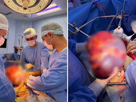 Врачи красноярской больницы вырезали у 78-летнего пенсионера гигантскую селезенку размером с голову. Фото: Краевая клиническая больница