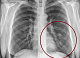 Красноярский пульмонолог показал, что внутри лёгких у вейпера