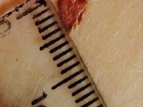 Жителям Красноярского края предлагают проверить родинки перед летом по фото онлайн. фото: Красноярский онкоцентр