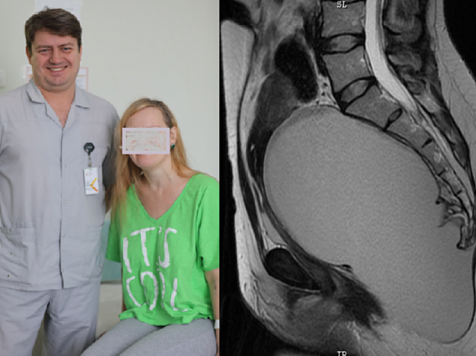 Хирурги вытащили у пациентки редкую гигантскую опухоль: женщина 40 лет не могла завести детей (фото). Фото: medgorod.ru