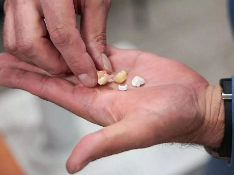 Красноярские ученые разработали высокопрочный материал для стоматологических имплантатов. Фото: пресс-служба СФУ