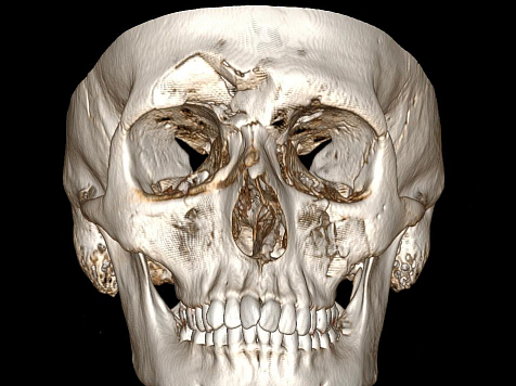 В Красноярске хирурги спасли лицо жителю Новосибирской области. Фото: <a href="http://bsmp.sibmedport.ru/article/687">Интересный клинический случай в практике челюстно-лицевых хирургов БСМП — gb6.sibmedport.ru</a>