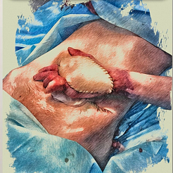 Красноярские врачи вшили бойцу руку в живот после тяжелого ожога