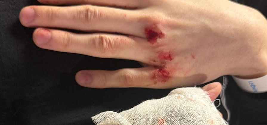 На красноярские травмпункты обрушилась сезонная волна пострадавших от самокатов